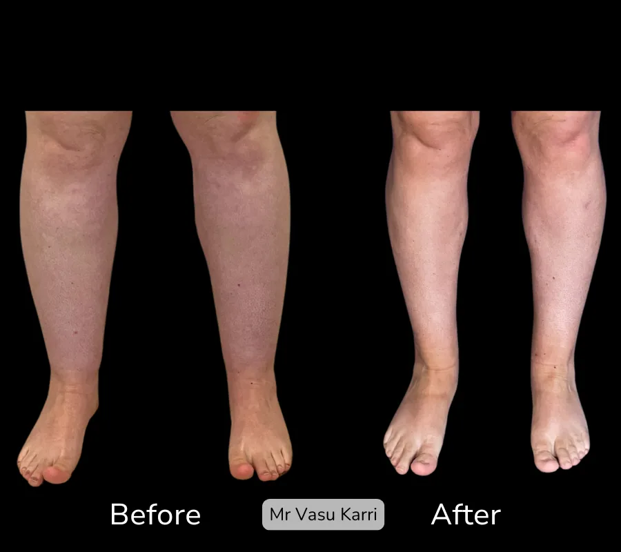 Before and after Cankle Surgery, patient 5