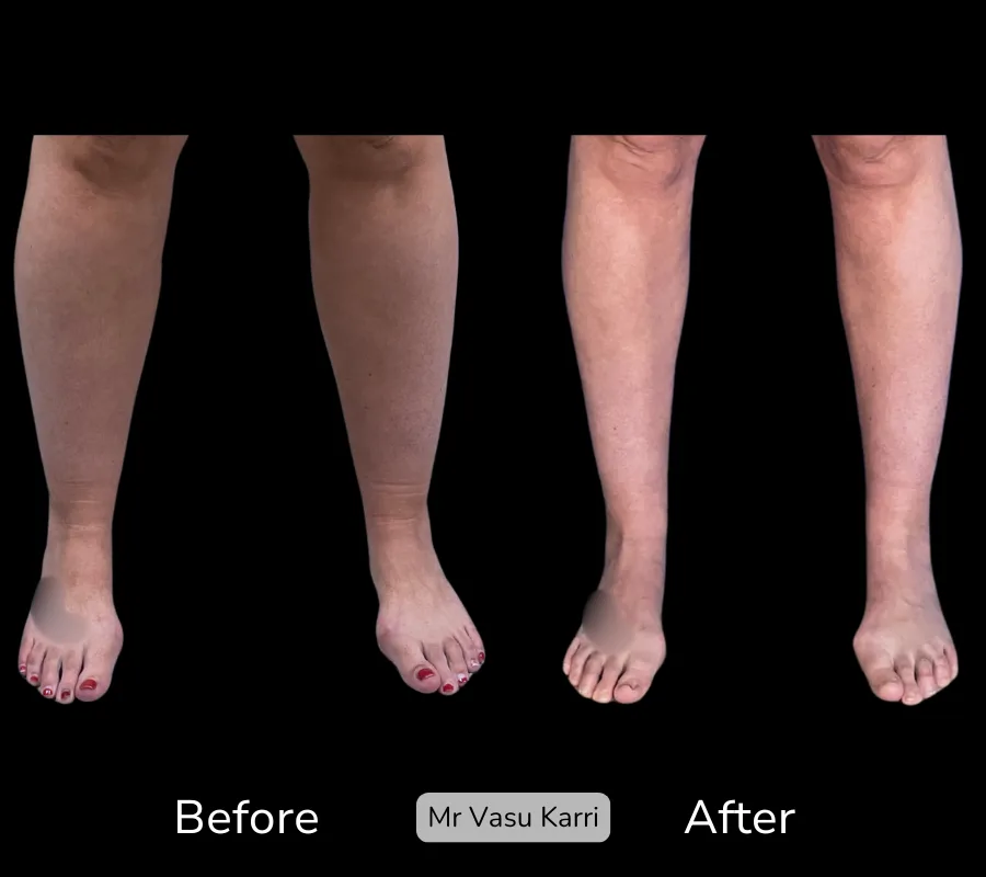 Before and after Cankle Surgery, patient 6