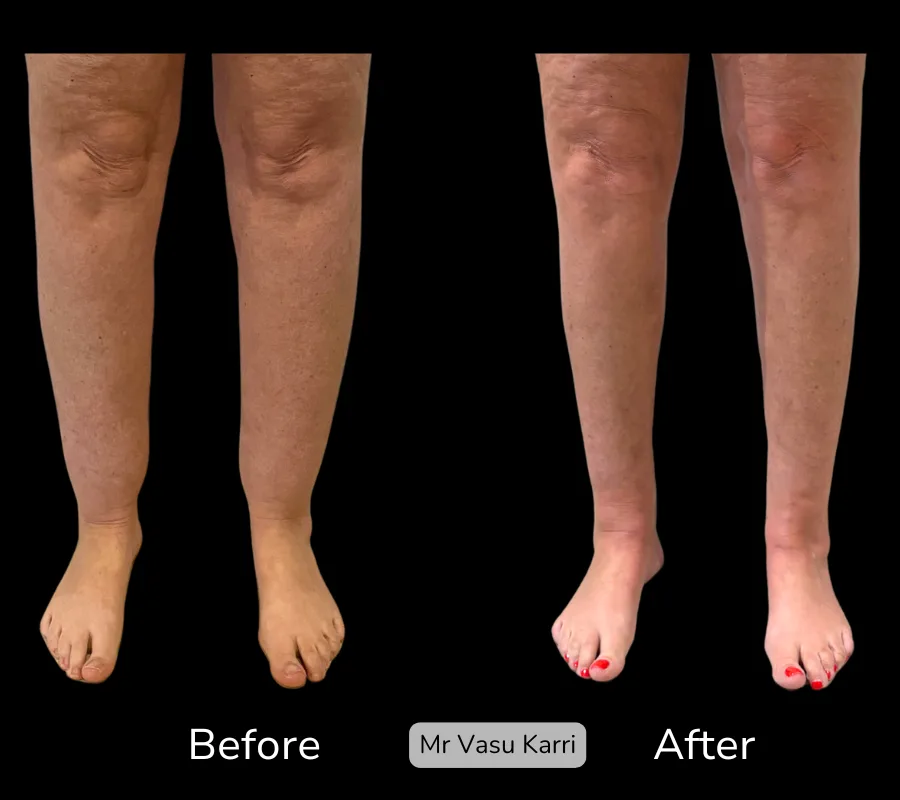 Before and after Cankle Surgery, patient 7