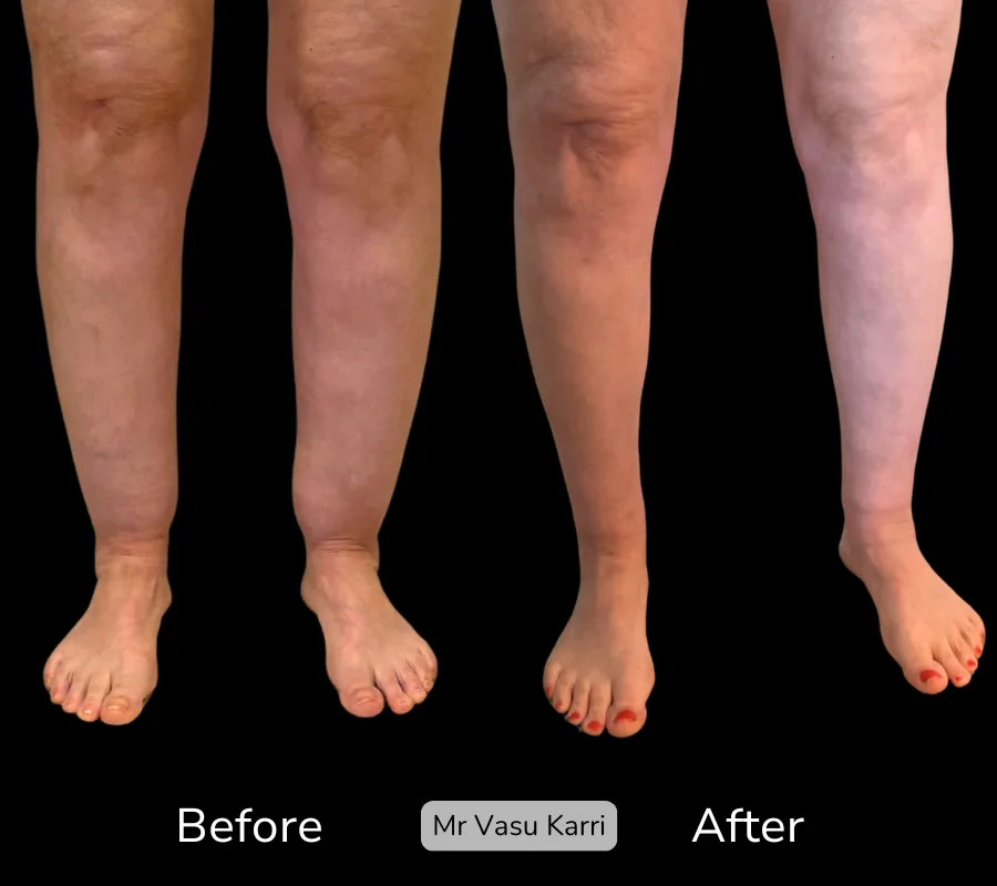 Before and after Cankle Surgery, patient 8