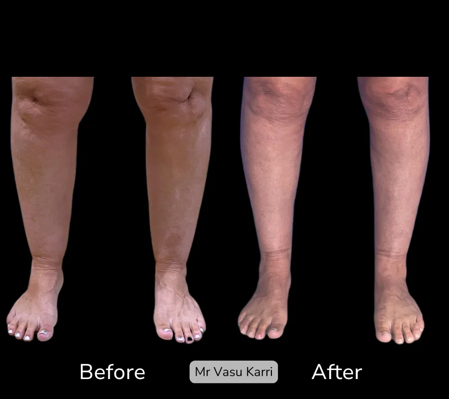 Before and after Cankle Surgery, patient 9