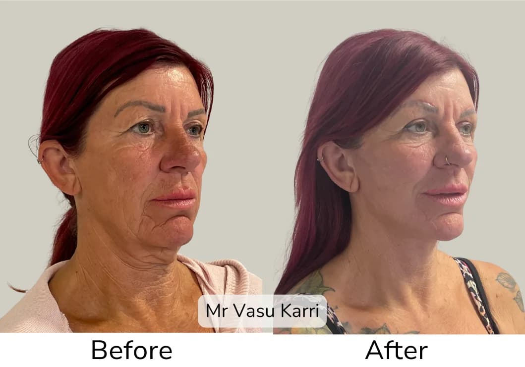 Before and after Phenol Peel, patient dpf-1
