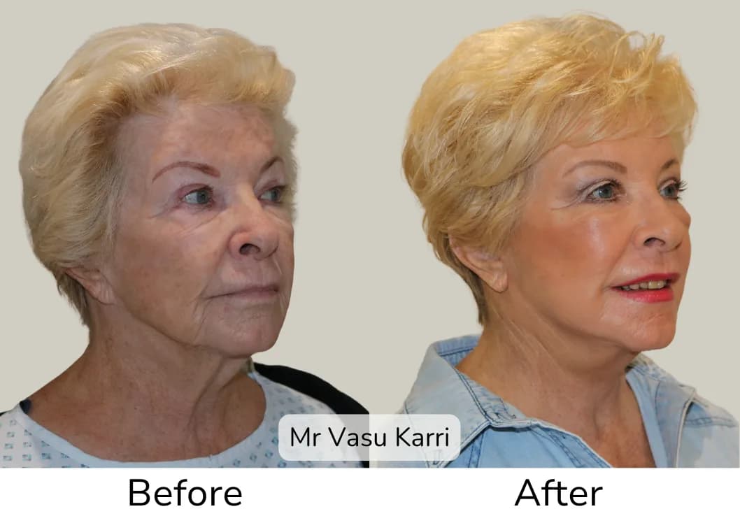 Before and after Phenol Peel, patient dpf-2