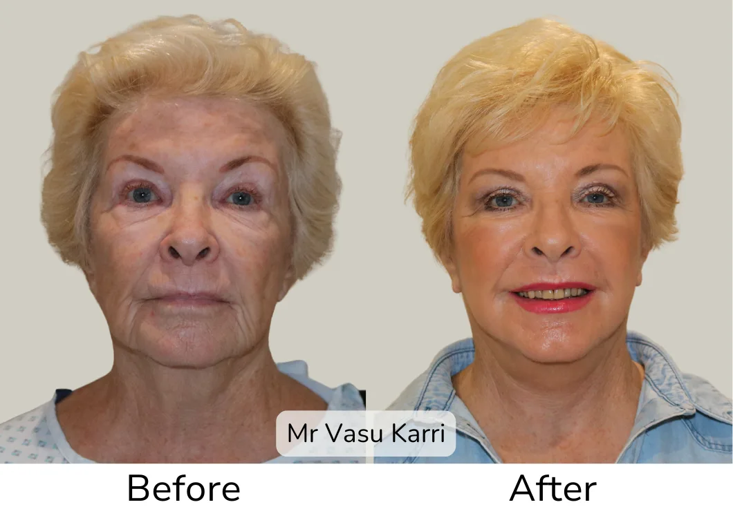 Before and after Phenol Peel, patient dpf-3