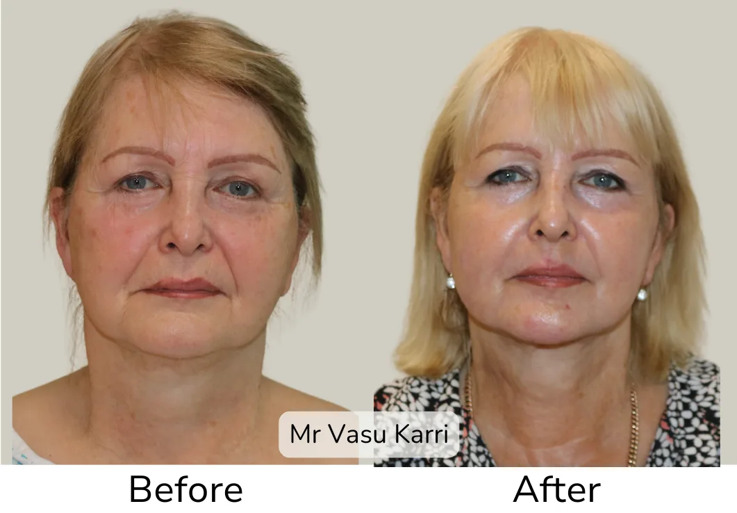 Before and after Phenol Peel, patient dpf-4