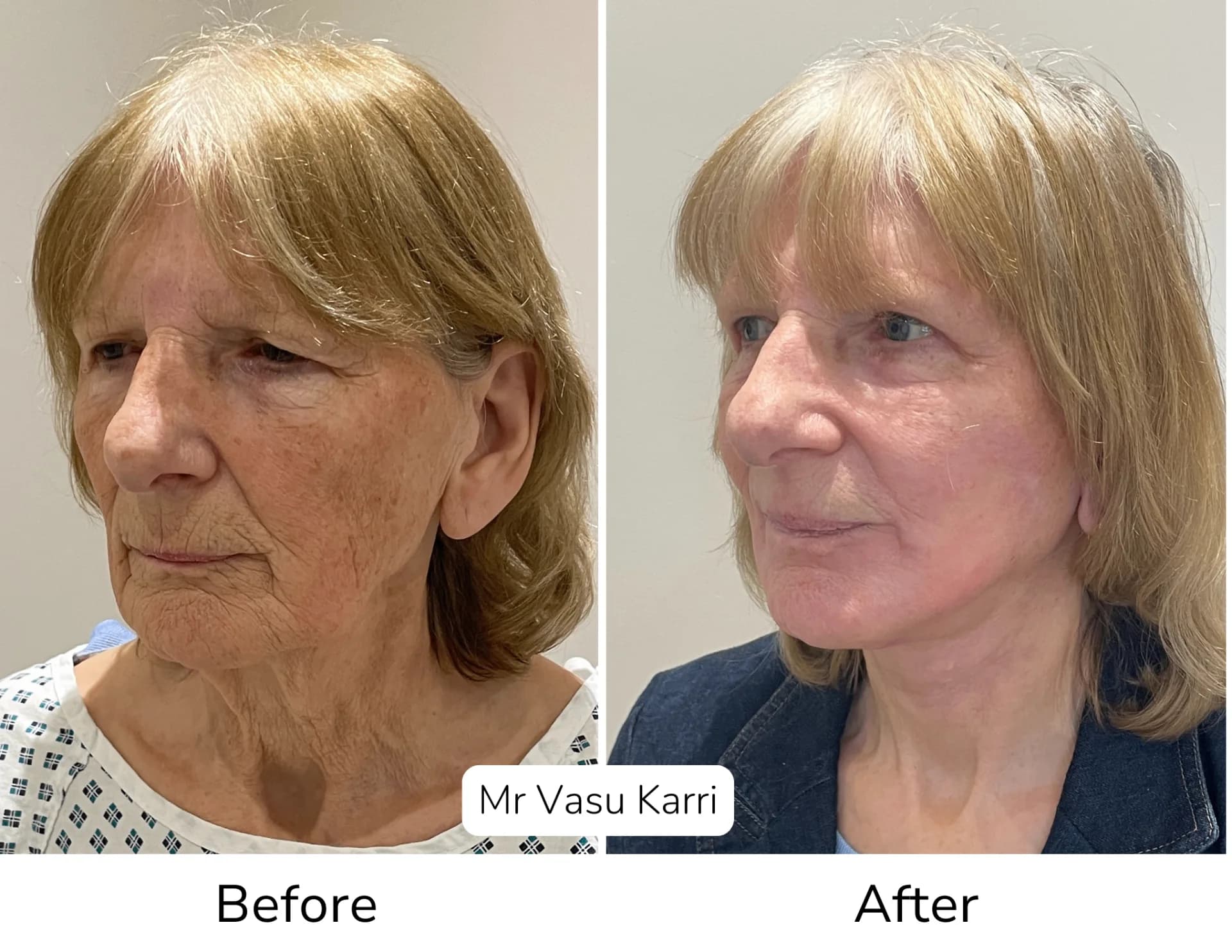 Before and after Phenol Peel, patient dpf-5