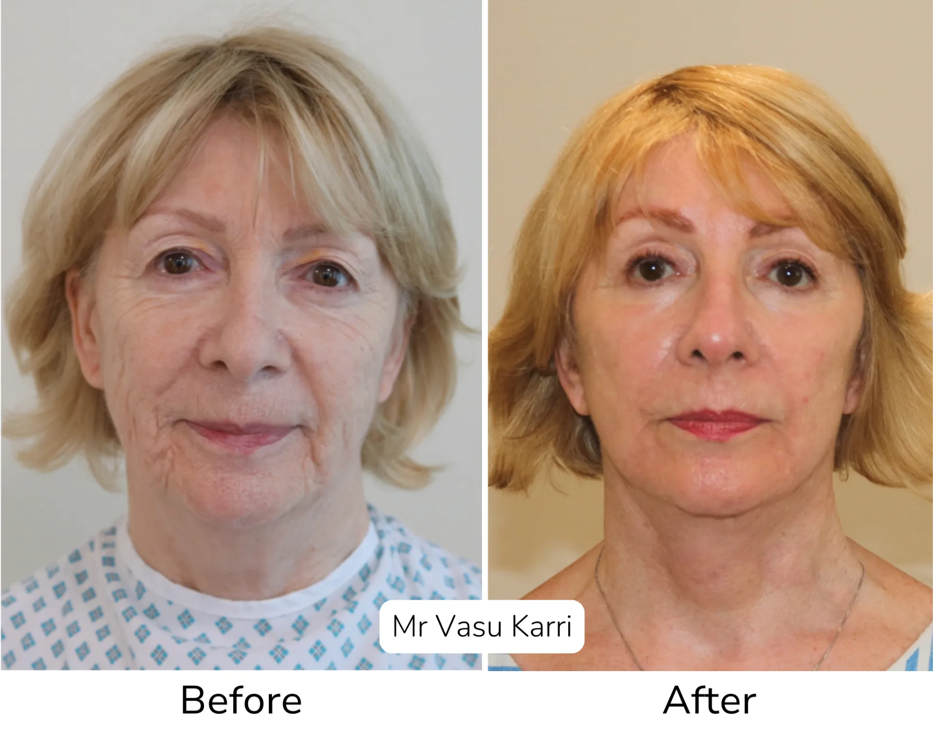 Before and after Phenol Peel, patient dpf-6