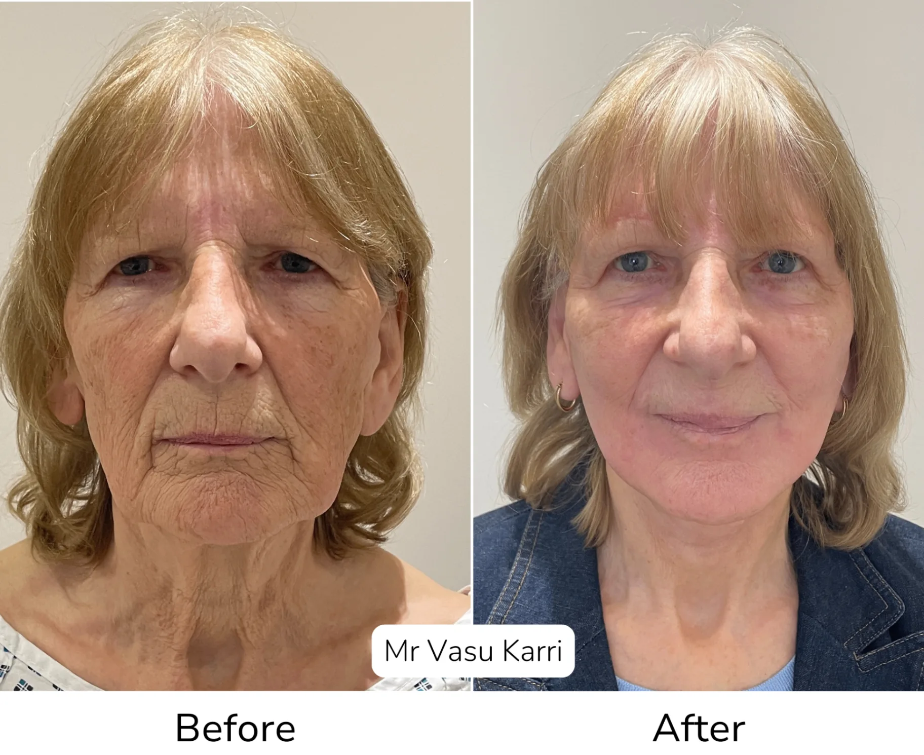 Before and after Phenol Peel, patient dpf-7