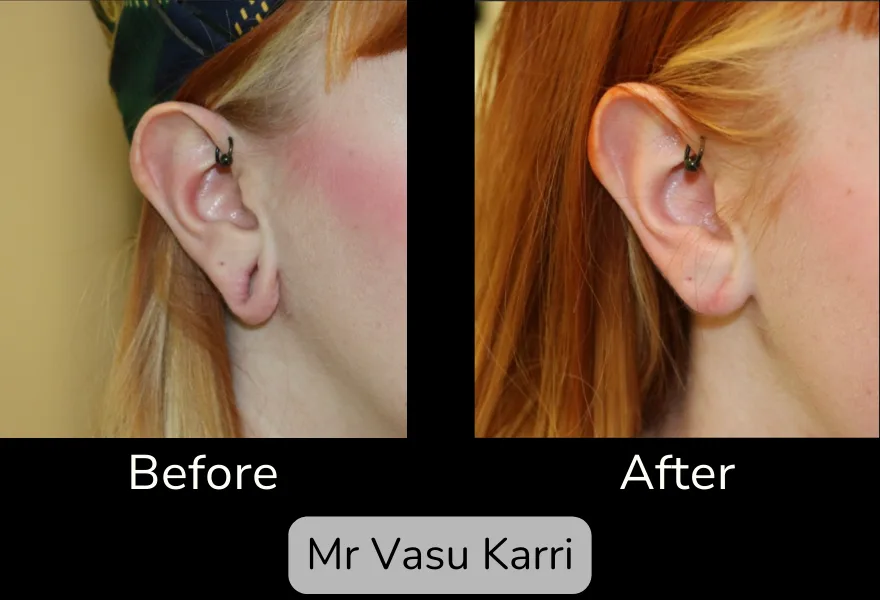 Before and after Earlobe Repair, patient 1