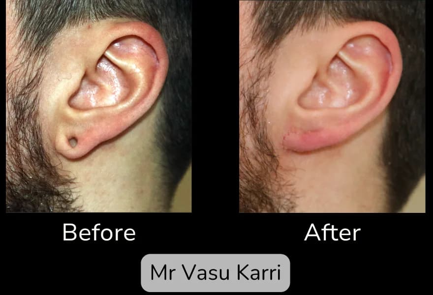 Before and after Earlobe Repair, patient 2