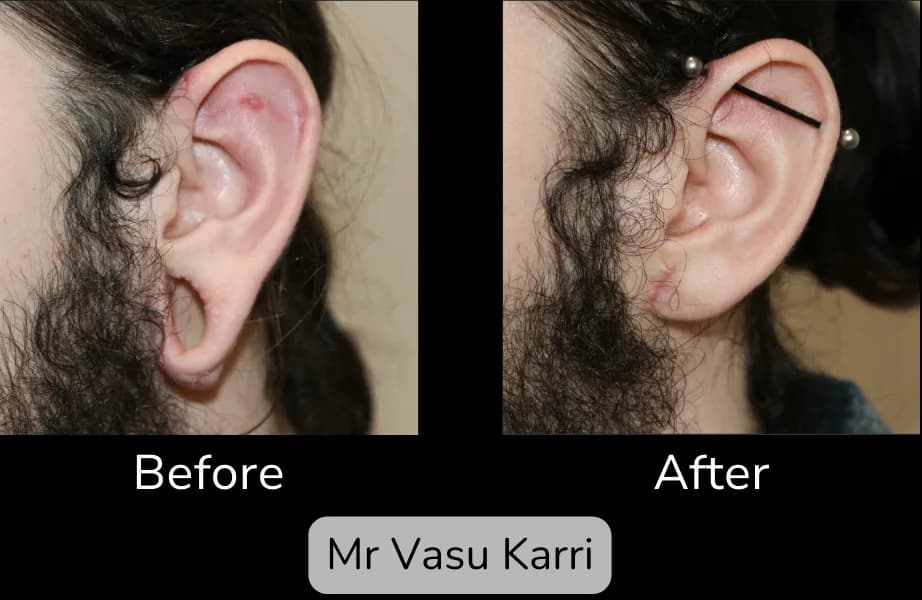 Before and after Earlobe Repair, patient 3