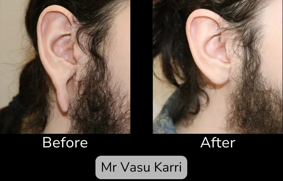 Before and after Earlobe Repair, patient 4