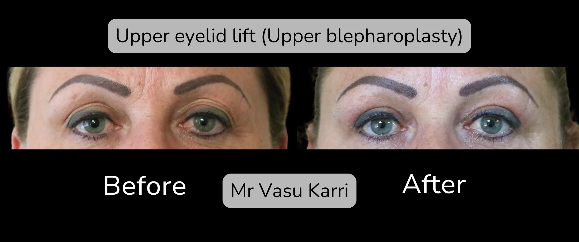 Before and after Eyelid Surgery, patient 1