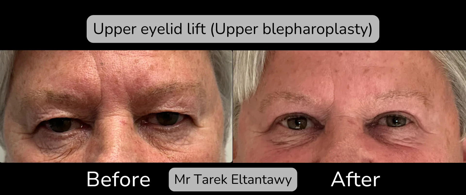 Before and after Eyelid Surgery, patient 9