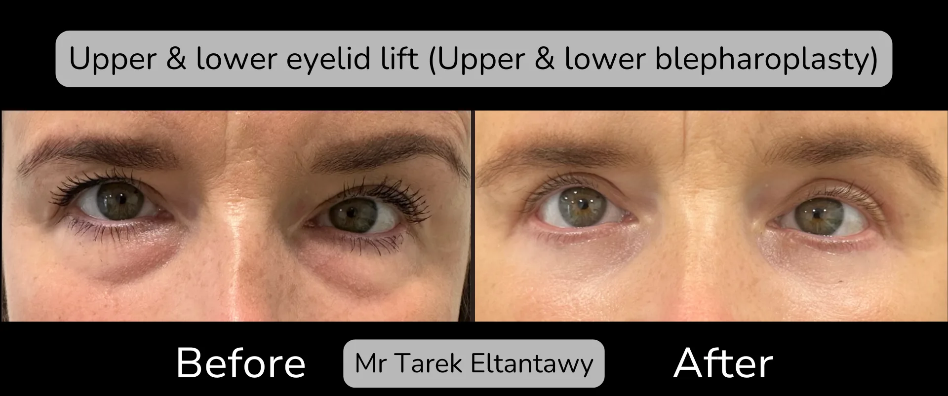 Before and after Eyelid Surgery, patient 10