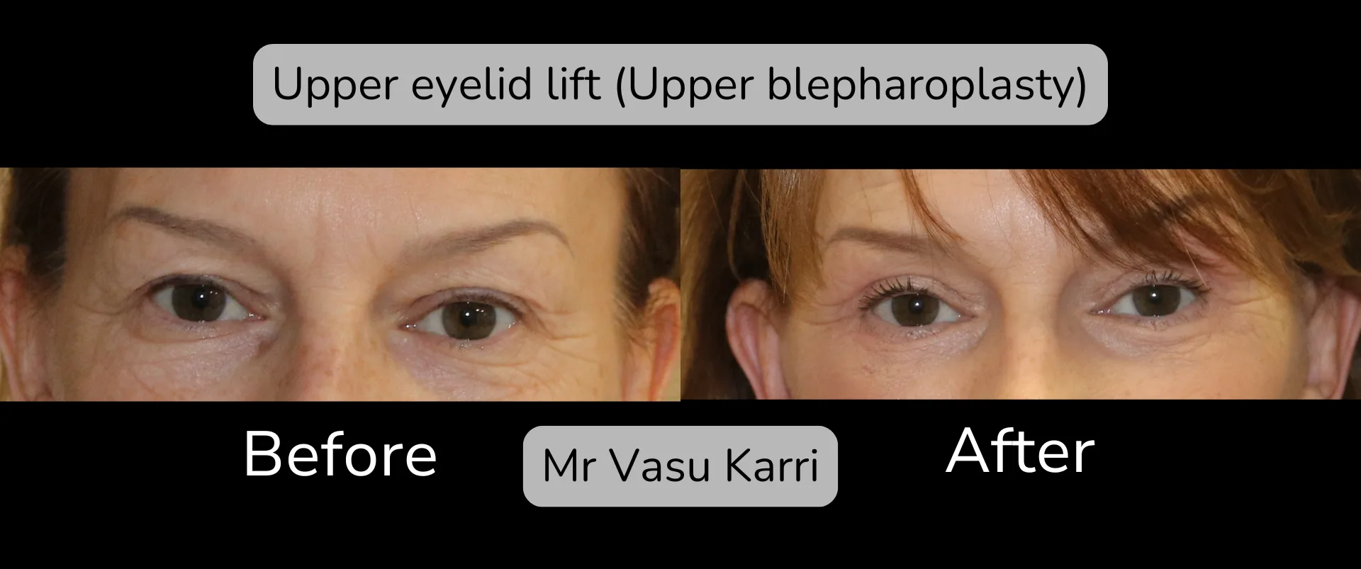 Before and after Eyelid Surgery, patient 2