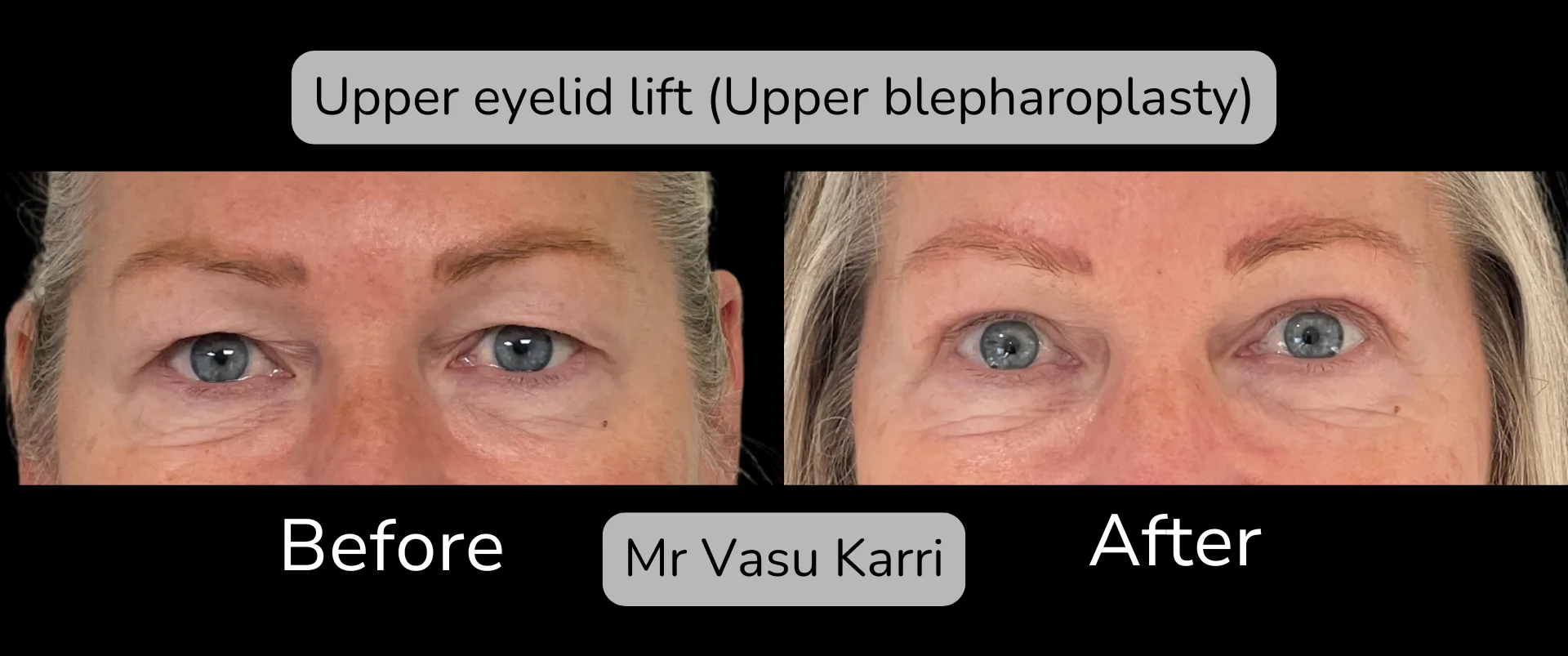 Before and after Eyelid Surgery, patient 3