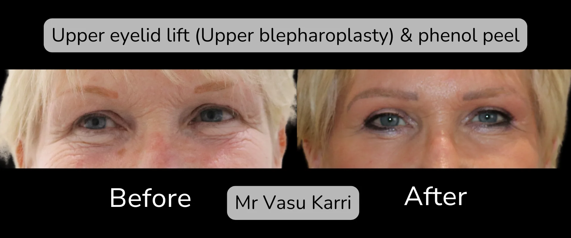 Before and after Eyelid Surgery, patient 4
