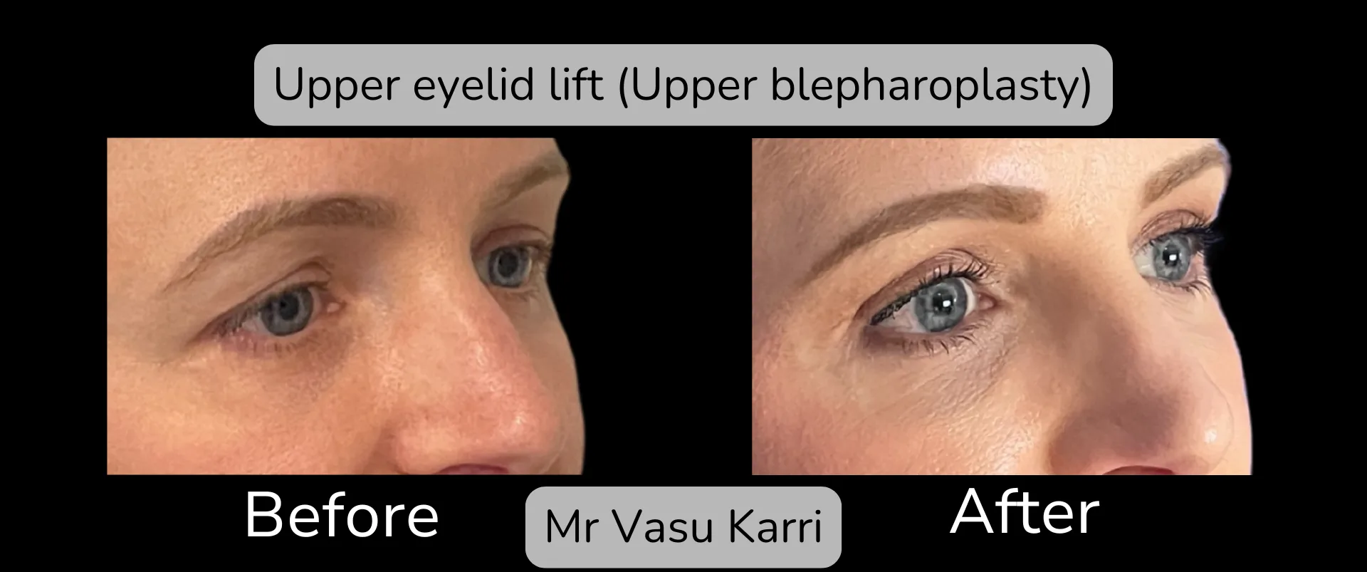 Before and after Eyelid Surgery, patient 5