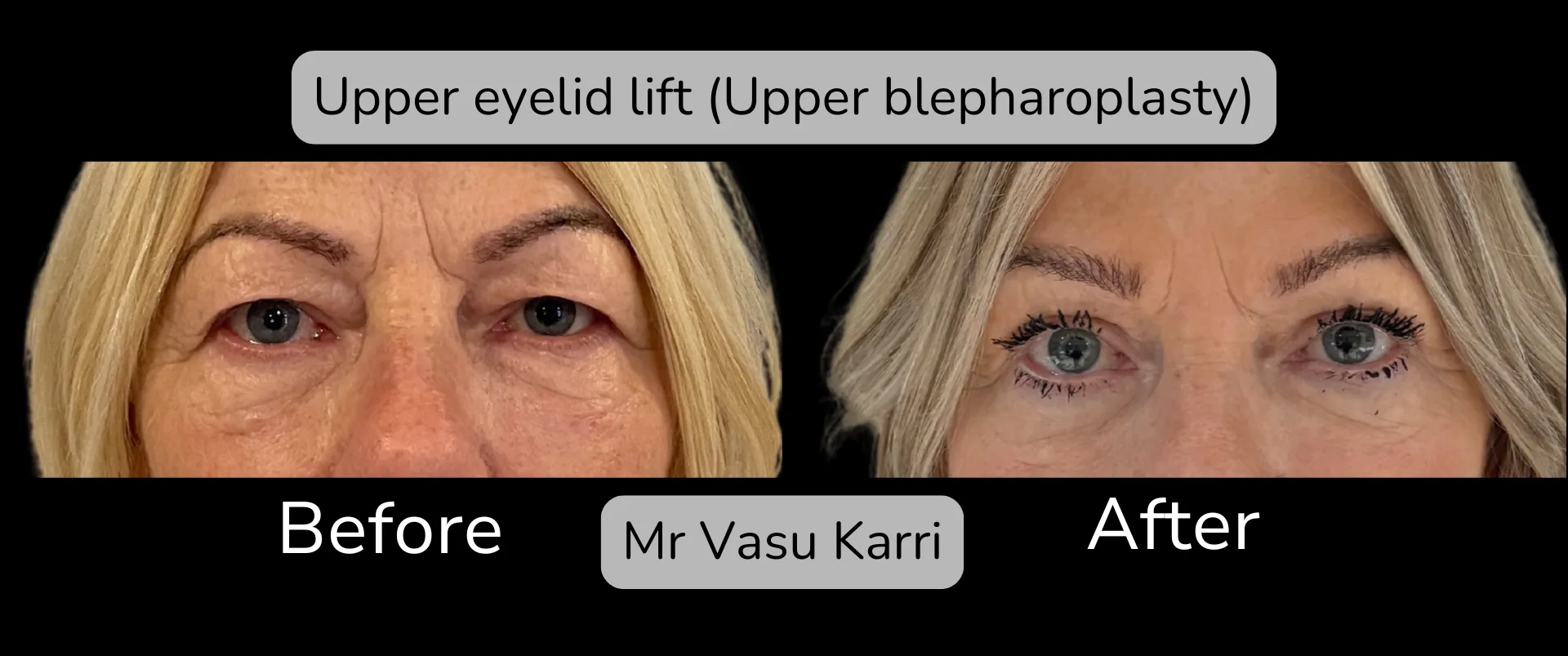 Before and after Eyelid Surgery, patient 6