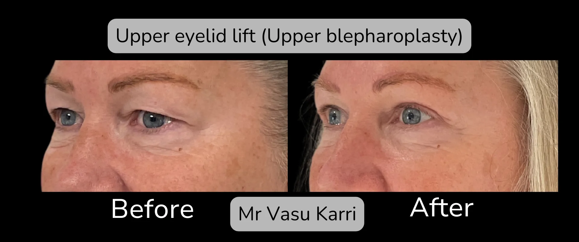 Before and after Eyelid Surgery, patient 7