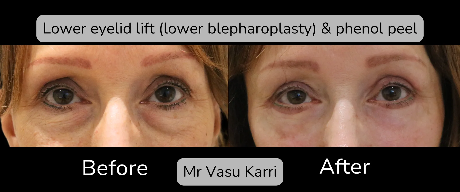 Before and after Eyelid Surgery, patient 8