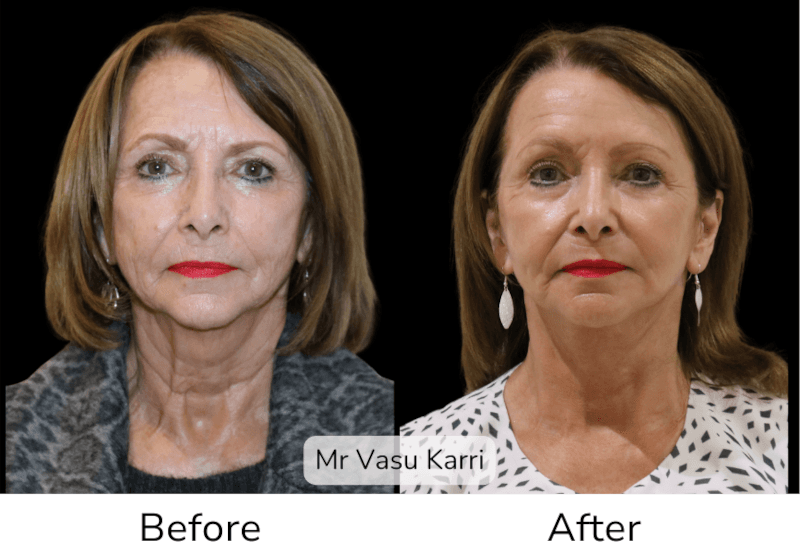Deep Plane Facelift: Natural Results from Specialist Plastic Surgeons Before & After 1