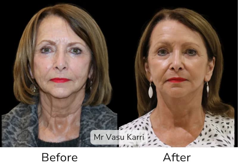 Before and after Deep Plane Face Lift/Neck Lift, patient 1
