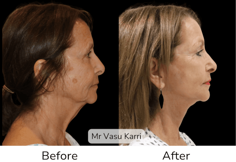 Deep Plane Facelift: Natural Results from Specialist Plastic Surgeons Before & After 2