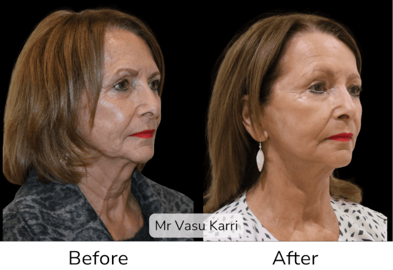 Deep Plane Facelift: Natural Results from Specialist Plastic Surgeons Before & After 3