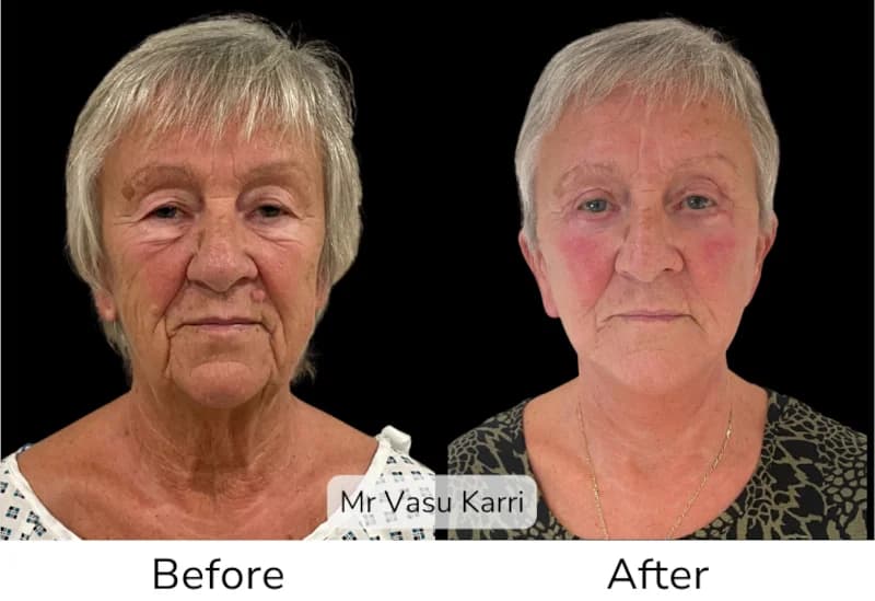 Before and after Deep Plane Face Lift/Neck Lift, patient 10