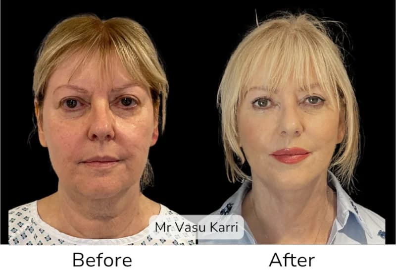 Before and after Deep Plane Face Lift/Neck Lift, patient 11