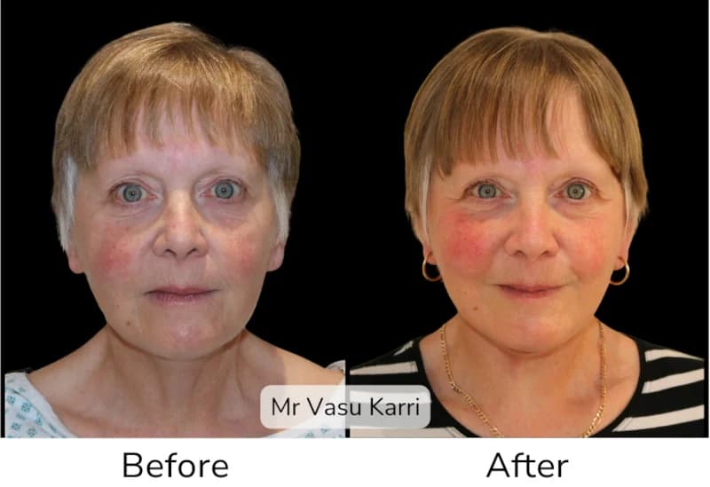 Before and after Deep Plane Face Lift/Neck Lift, patient 12