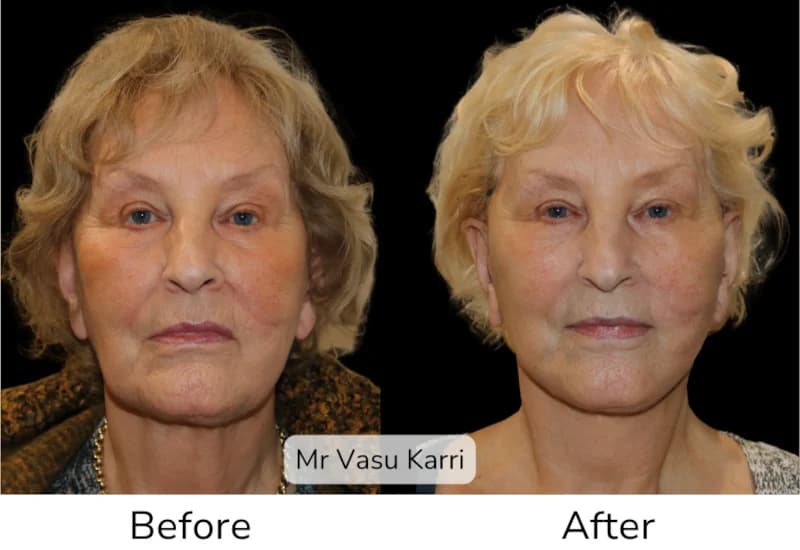 Before and after Deep Plane Face Lift/Neck Lift, patient 13