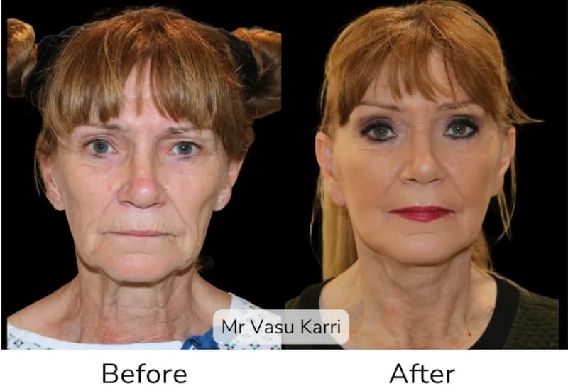 Before and after Deep Plane Face Lift/Neck Lift, patient 14
