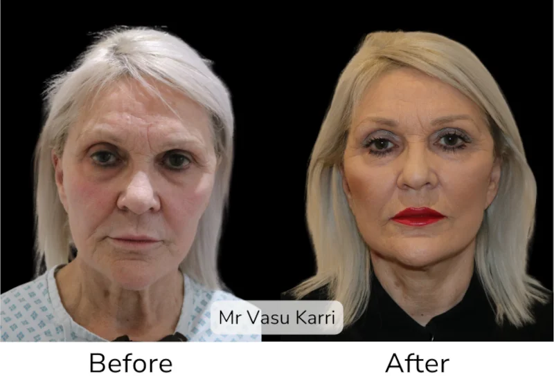 Before and after Deep Plane Face Lift/Neck Lift, patient 15