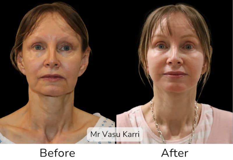 Before and after Deep Plane Face Lift/Neck Lift, patient 16