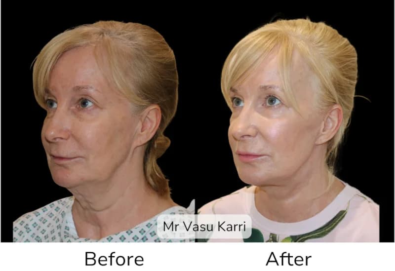 Before and after Deep Plane Face Lift/Neck Lift, patient 17