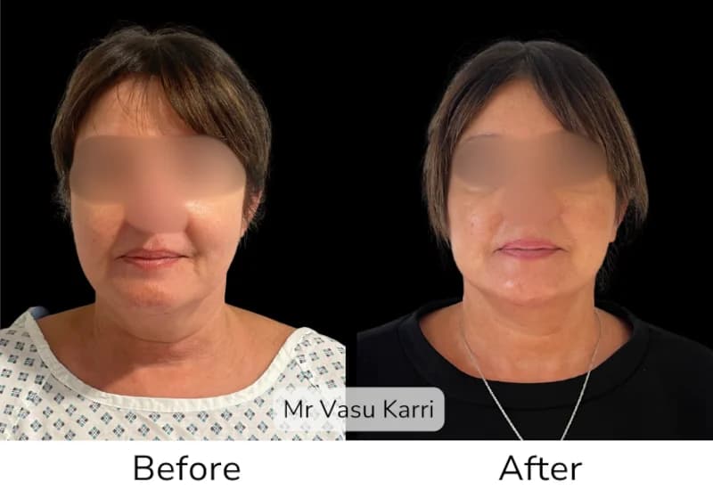 Before and after Deep Plane Face Lift/Neck Lift, patient 18