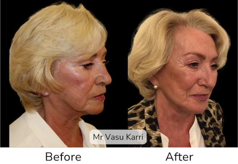 Before and after Deep Plane Face Lift/Neck Lift, patient 19