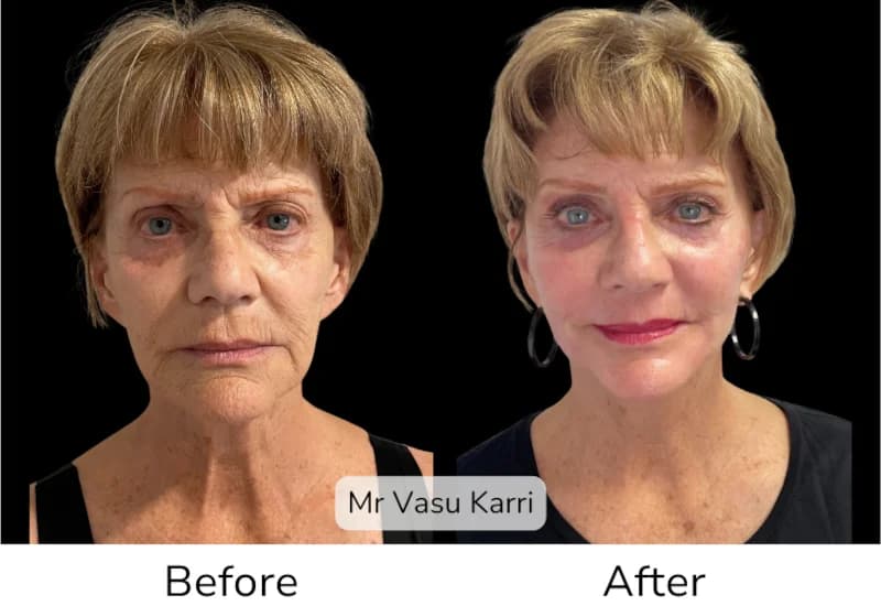 Before and after Deep Plane Face Lift/Neck Lift, patient 2