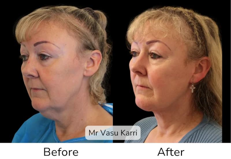 Before and after Deep Plane Face Lift/Neck Lift, patient 20
