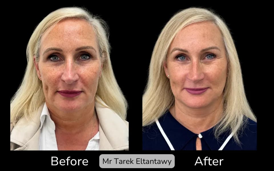 Before and after Deep Plane Face Lift/Neck Lift, patient 21
