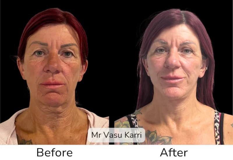 Before and after Deep Plane Face Lift/Neck Lift, patient 3