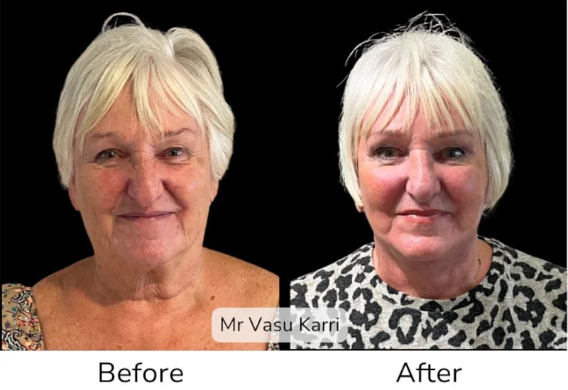 Before and after Deep Plane Face Lift/Neck Lift, patient 4
