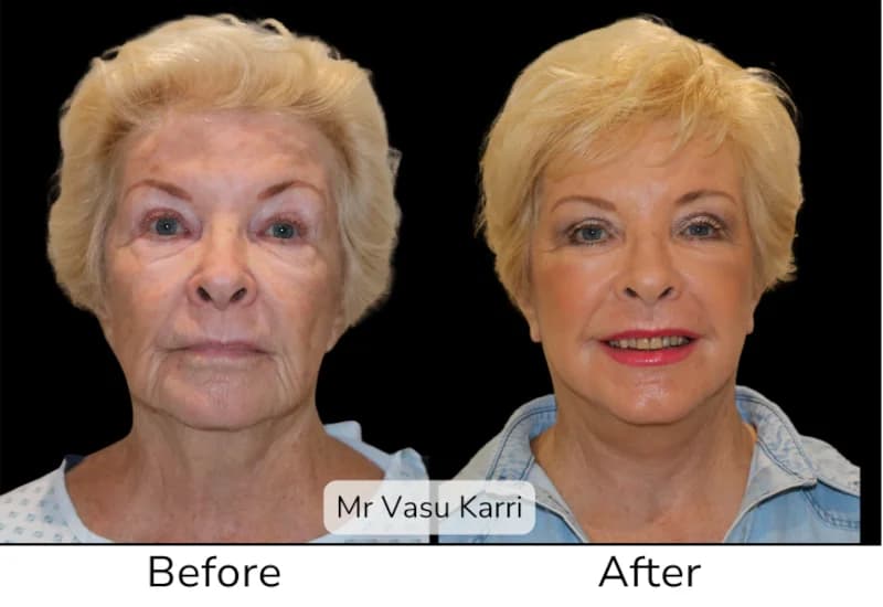 Before and after Deep Plane Face Lift/Neck Lift, patient 5