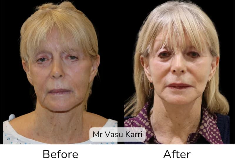 Before and after Deep Plane Face Lift/Neck Lift, patient 6