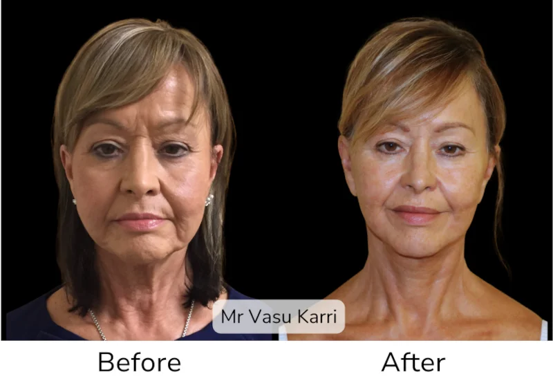 Before and after Deep Plane Face Lift/Neck Lift, patient 7