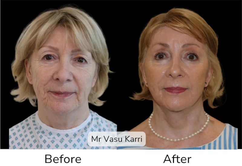 Before and after Deep Plane Face Lift/Neck Lift, patient 8