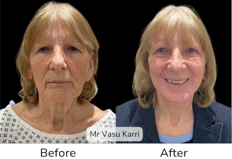 Before and after Deep Plane Face Lift/Neck Lift, patient 9